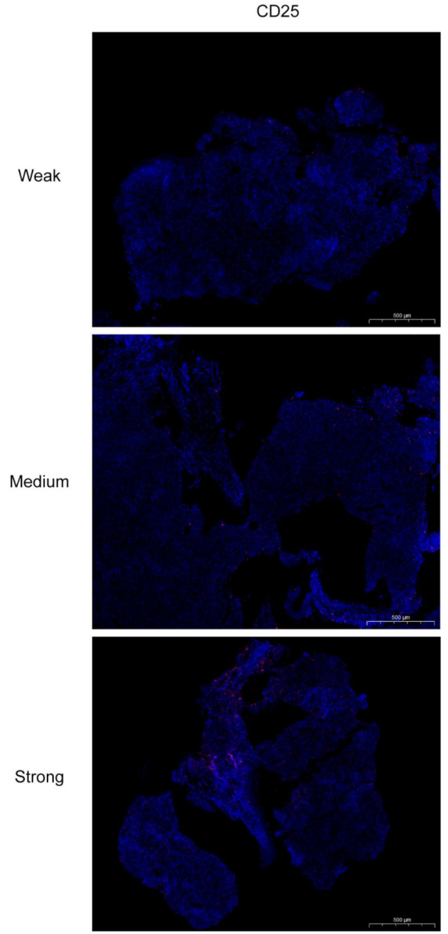 Tumor-infiltrating CD4<sup>+</sup> CD25<sup>+</sup> FOXP3<sup>+</sup> Treg is associated with plasma EBV DNA and disease progression in nasopharyngeal carcinoma.