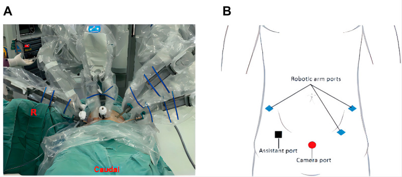 Robot-assisted laparoscopic retroperitoneal lymph node dissection in testicular cancer using a single-position supine approach: A case report and literature review.