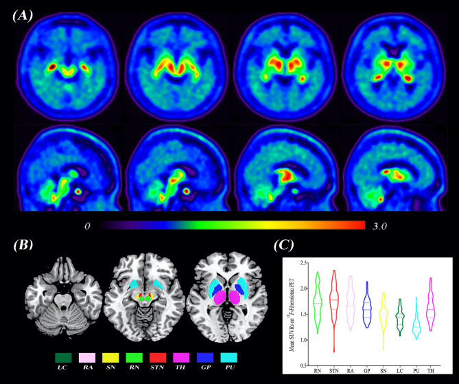 Choroid plexus enlargement correlates with subcortical tau deposition in progressive supranuclear palsy.