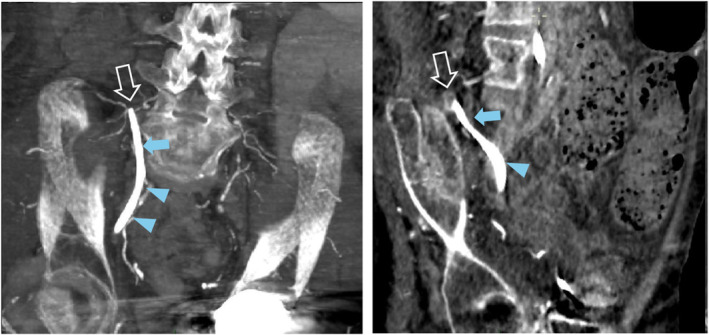 From Venous to Arterial Blood in the Same Tunneled Dialysis Catheter After Starting a Continuous Renal Replacement Therapy: A Case Report.