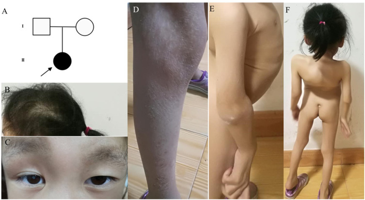A Novel EBP c.452A>G Mutation Identified in a Girl with Conradi-Hünermann-Happle Syndrome Presenting with Hydronephrosis.