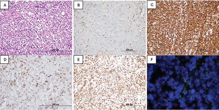 A Rare Case of Non-Hodgkin Lymphoma Presenting as a Penile Mass