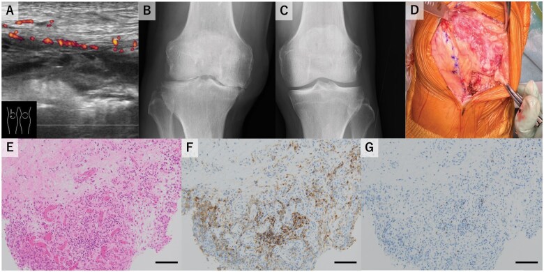 Immune checkpoint inhibitor-induced inflammatory arthritis with severe joint destruction requiring knee arthroplasty.