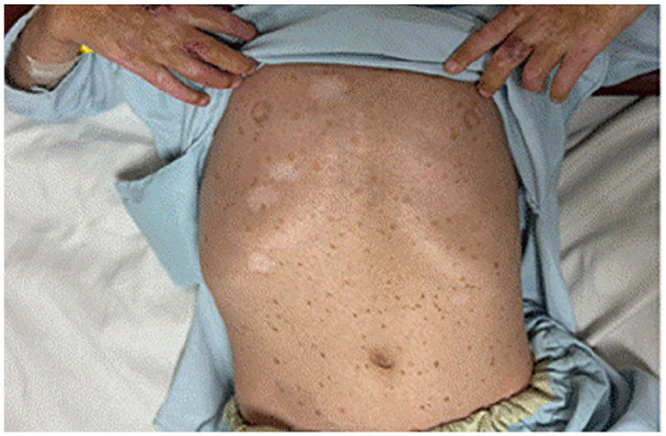 Unique Dermatological and Systemic Manifestations in a Classic Pediatric Case of Kindler Syndrome: A Case Report and Literature Review.