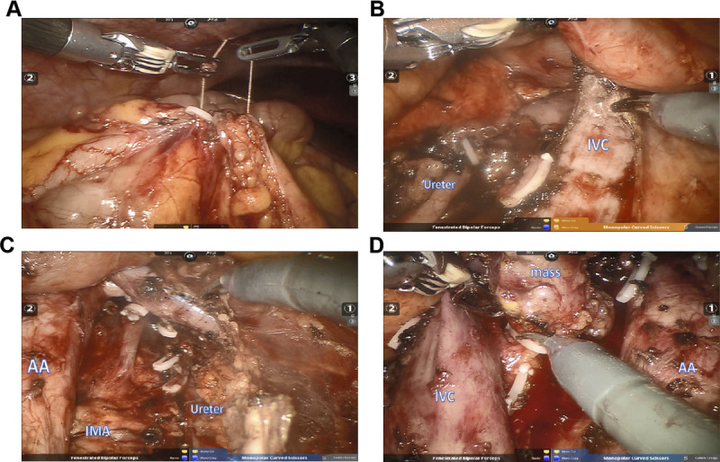 Robot-assisted laparoscopic retroperitoneal lymph node dissection in testicular cancer using a single-position supine approach: A case report and literature review.
