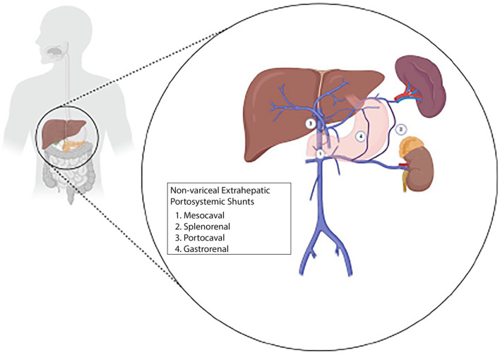 Non-variceal Extrahepatic Portosystemic Shunts: A Review of Pathogenesis, Diagnosis, and Treatment.