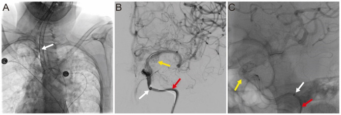 Feasibility and safety of 0.018-inch guidewire-supported distal access catheters in establishing transradial neurointerventional access.