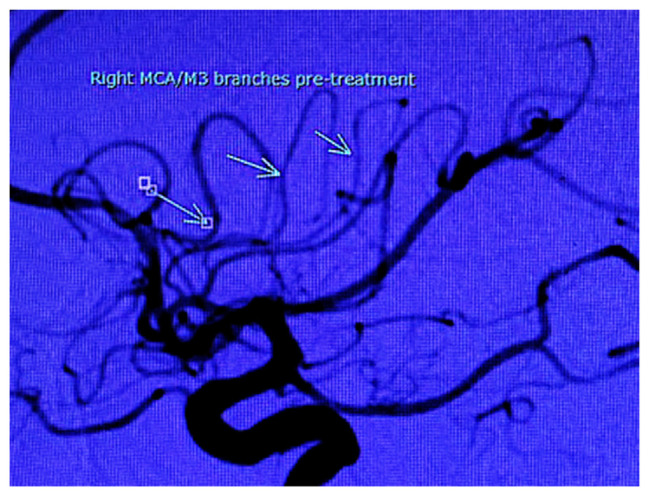 Reversible Cerebral Vasoconstriction Syndrome Induced by Sumatriptan: A Case Report and Review of Literature.