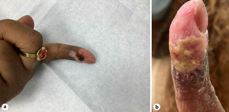 Management of Resistant Herpetic Whitlow: A Case of Recurrent Herpetic Whitlow Resistant to Standard Therapy.