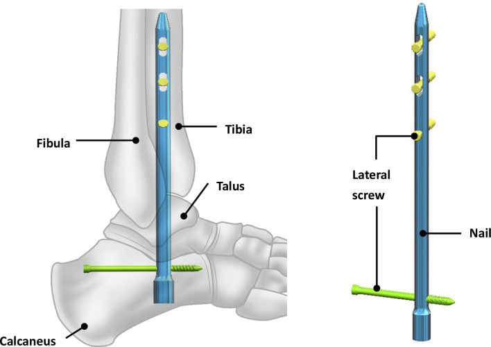 Biomechanical design considerations of a 3D-printed tibiotalocalcaneal nail for ankle joint fusion.