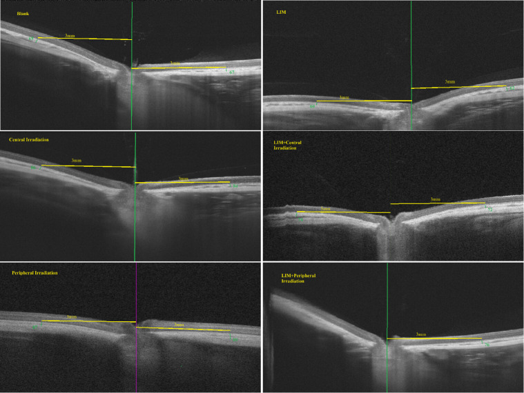 Peripheral retinal irradiation with low-energy red light can effectively and safely delay the progression of myopia.
