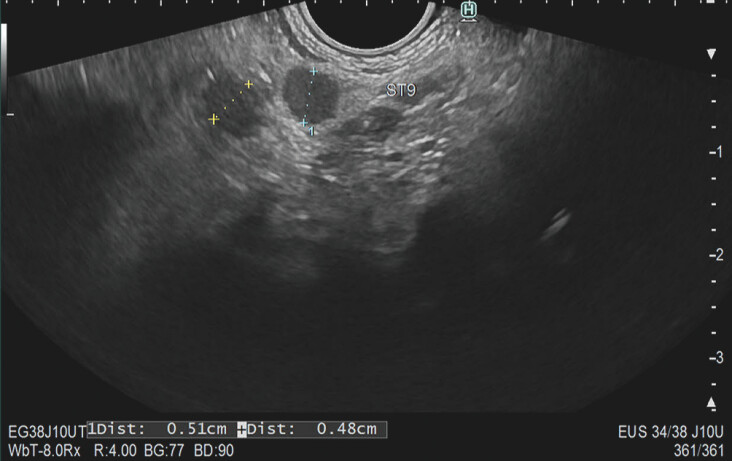 Interobserver variability in lymph node evaluation with endoscopic ultrasonography in cholangiocarcinoma.