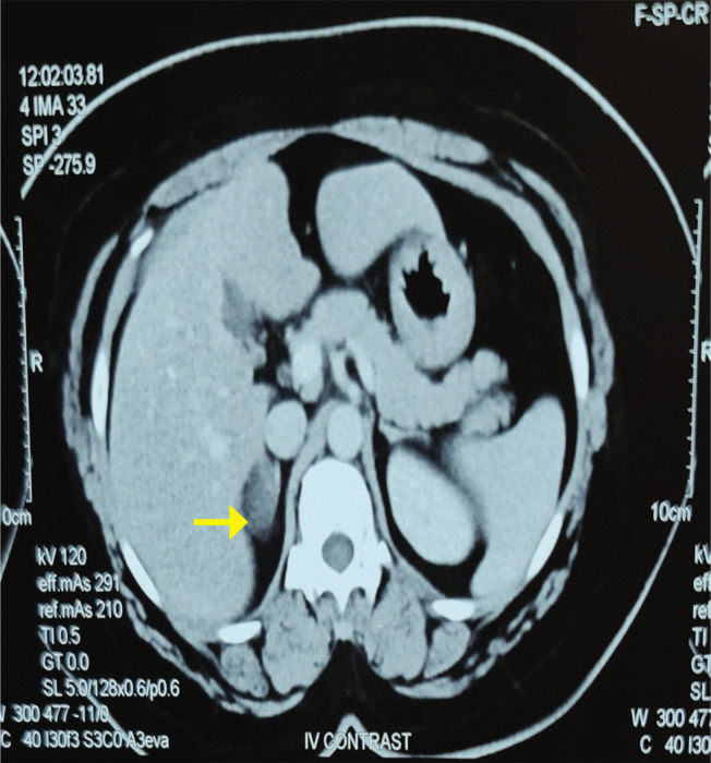 A Rare Case of Catecholamine-Secreting Adrenal Myelolipoma.