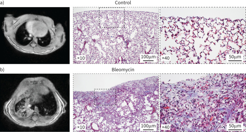 Insights into interstitial lung disease pathogenesis.