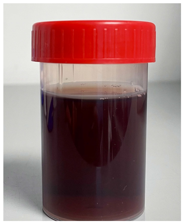 Cefiderocol-associated chromaturia, a secondary side effect to recognize.