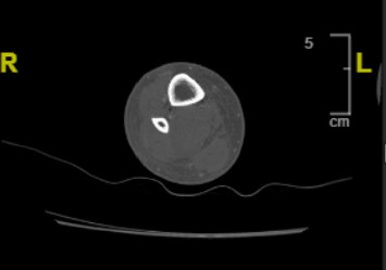 From Throat to Limb: A Novel Case of Compartment Syndrome Following Group A Streptococcal Pharyngitis.