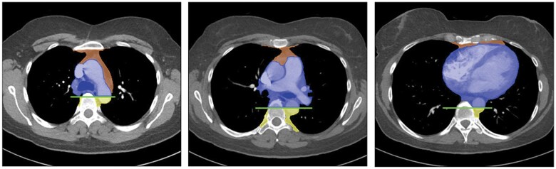 A diagnostic approach to mediastinal masses in clinical practice.