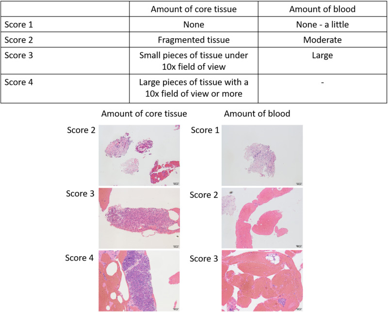 Evaluation of the 22G Franseen needle and 22G Lancet needle for endoscopic ultrasonography-guided tissue acquisition sampling in solid pancreatic lesions: Propensity score weighting.