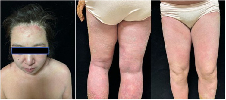Generalized Pustular Psoriasis During Early Pregnancy Successfully Treated with Spesolimab: A Case Report.