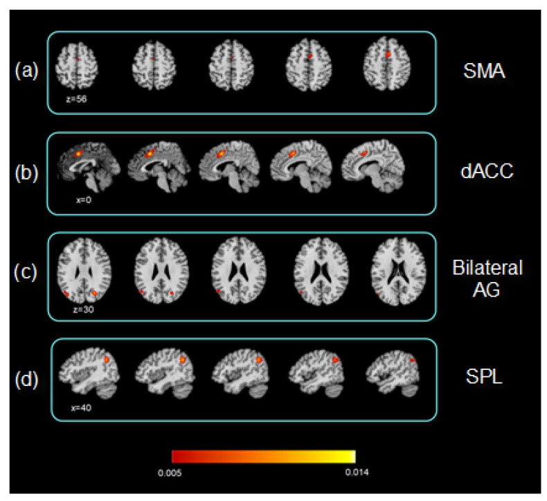 Functional and Structural Alterations in Pediatric Multiple Sclerosis: A Systematic Review and a Preliminary Activation Likelihood Estimation Functional Magnetic Resonance Imaging Meta-Analysis.