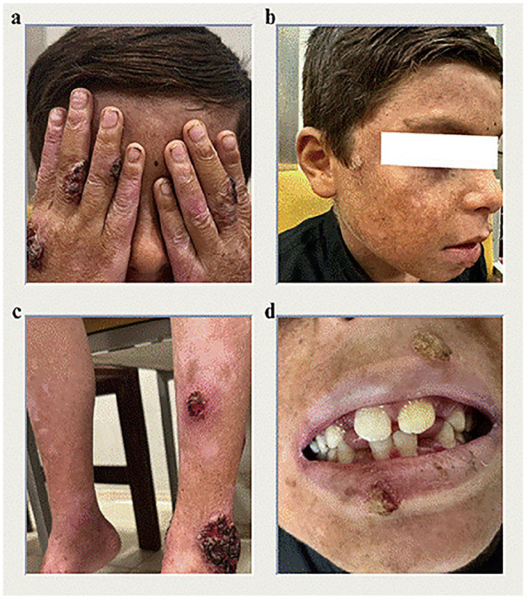 Unique Dermatological and Systemic Manifestations in a Classic Pediatric Case of Kindler Syndrome: A Case Report and Literature Review.