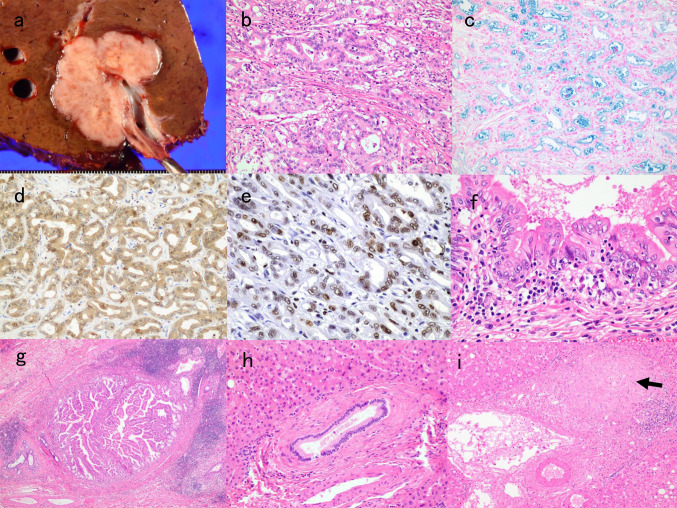 Subsequent development of cholangiocarcinoma caused by exposure to 1,2-dichloropropane and/or dichloromethane in the printing company in Osaka, Japan.