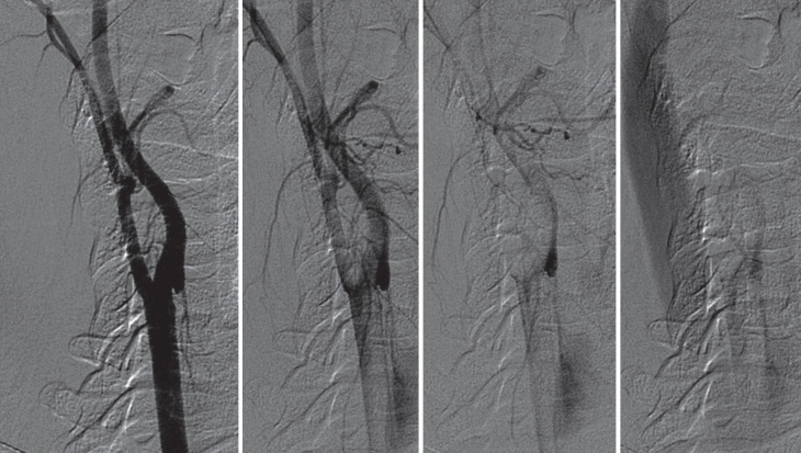 Carotid Web: An Update Focusing on Its Relationship With Fibromuscular Dysplasia and Therapeutic Strategy.