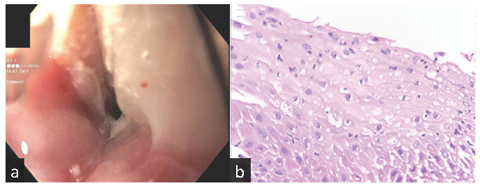 Mycophenolate-Induced Dysphagia in a Kidney Transplant Recipient.