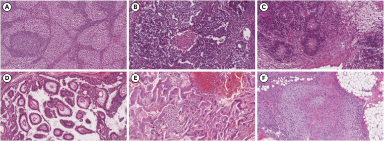 Malignant germ cells tumor of the ovary.