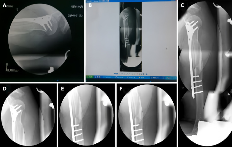 Parallax-free panoramic X-ray imaging combined with minimally invasive plate osteosynthesis for treating proximal humeral shaft fractures.