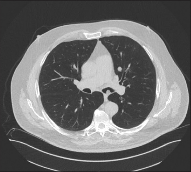 Endobronchial hamartoma; are the lines fading from the zebra? Case series and review of literature.