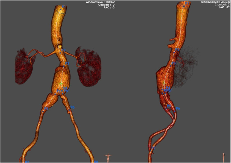 Preservation of Blood Flow to the Internal Iliac Artery Using a Custom-Made Single Fenestrated Endograft: A Case Report.