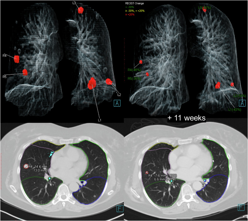 Artificial intelligence-based automated matching of pulmonary nodules on follow-up chest CT.