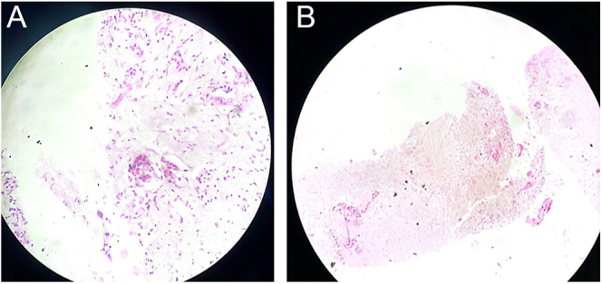 New-onset type 2 diabetes mellitus complicated by diabetic ketoacidosis: a sentinel presentation of advanced pancreatic adenocarcinoma.