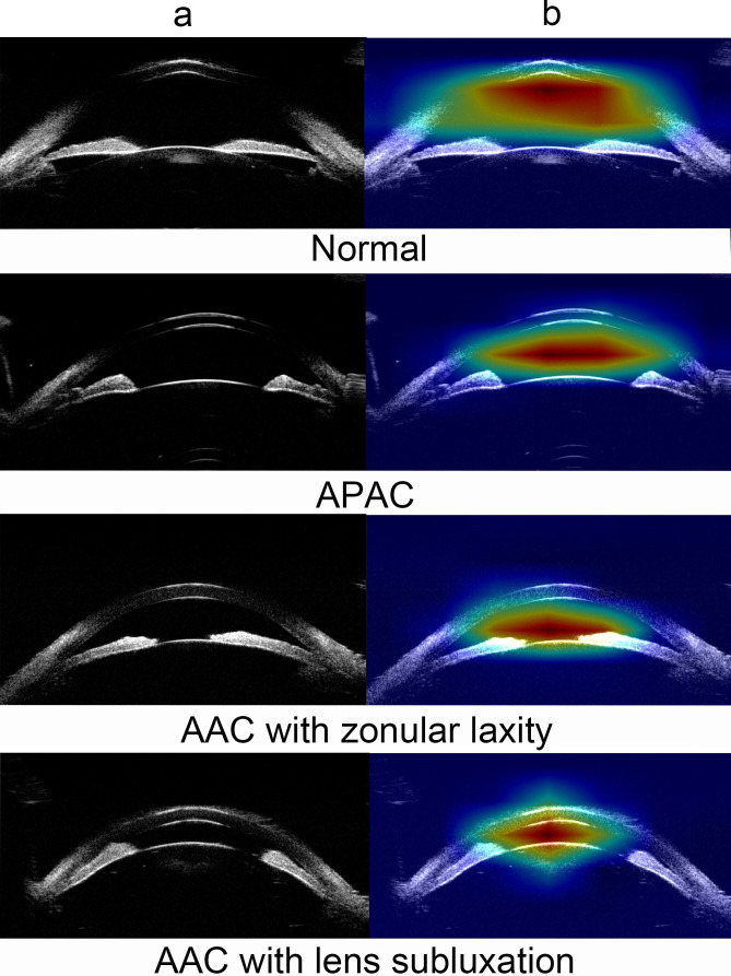 Deep learning-based automatic differentiation of acute angle closure with or without zonulopathy using ultrasound biomicroscopy: a comparison of diagnostic performance with ophthalmologists.