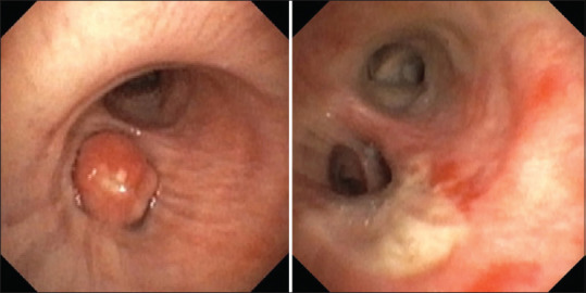 Endobronchial hamartoma; are the lines fading from the zebra? Case series and review of literature.