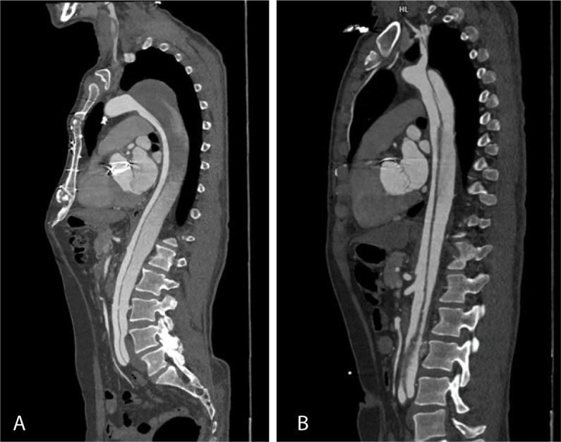 Fate of Residual Aorta After Surgery for Type A Aortic Dissection.