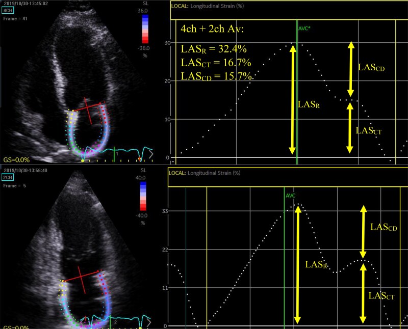 An echocardiographic prognostic risk stratification decision tree to determine adverse events in Anderson-Fabry disease.