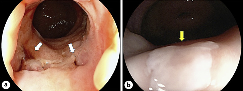 A Case of Postoperative Pouch-Vaginal Fistula of Ulcerative Colitis Successfully Treated with Estriol Vaginal Tablet.