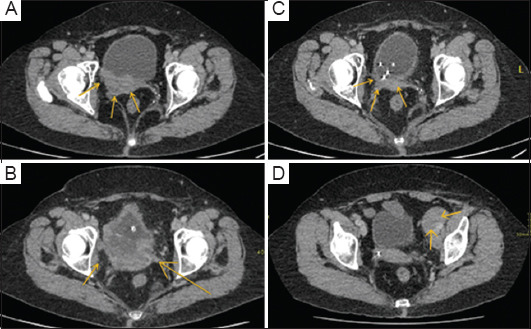 Potential synergistic effect of radiotherapy and immune checkpoint inhibitors on advanced bladder cancer: A case report.
