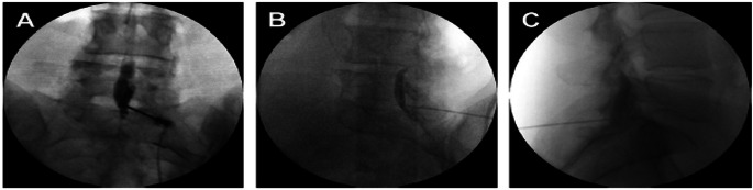 Epidural Contrast Patterns and Clinical Implications: An Educational Review.