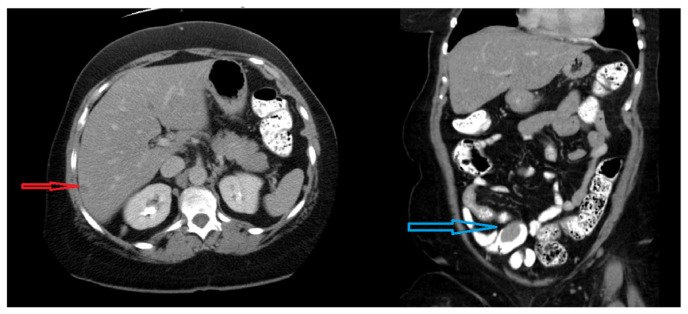 A Rare Discovery of Neuroendocrine Tumor: Cardiac Mass.