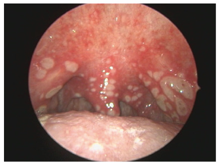 A Case of Doxycycline-Induced Esophagitis Accompanied by Oral Aphthous Ulcers and Laryngitis.