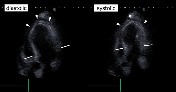 A case of abnormal hypertension and Takotsubo syndrome caused by adrenal hemostasis using an electric scalpel: a case report.