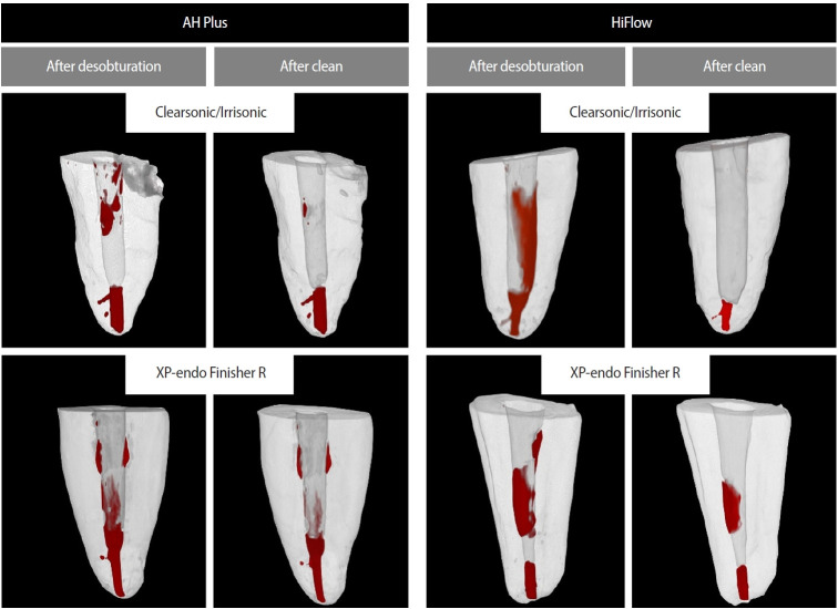 Cleaning protocols to enhance bond strength of fiberglass posts on root canals filled with bioceramic sealer: an in vitro comparative study.