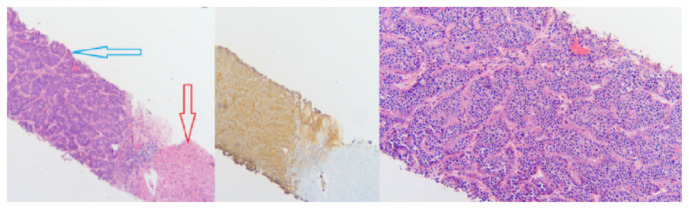 A Rare Discovery of Neuroendocrine Tumor: Cardiac Mass.