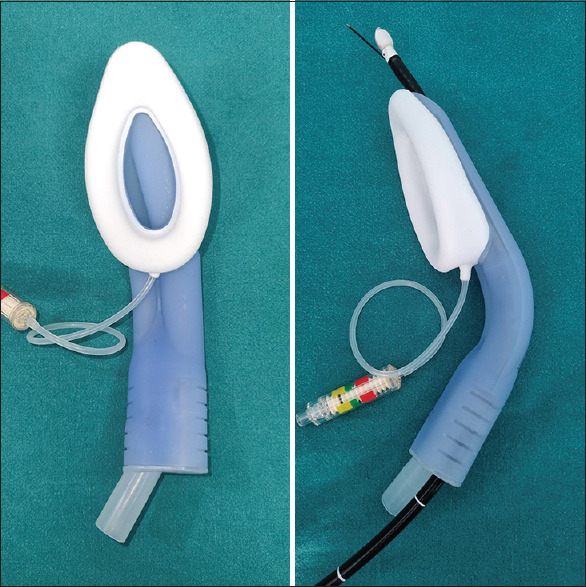 EBUS guided trans-esophgeal cryobiopsy-two case reports.