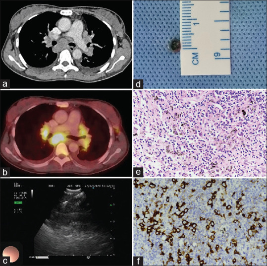 EBUS guided trans-esophgeal cryobiopsy-two case reports.