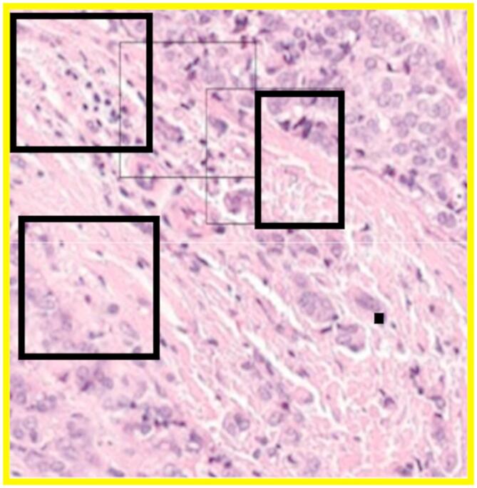 Histopathological image based breast cancer diagnosis using deep learning and bio inspired optimization.