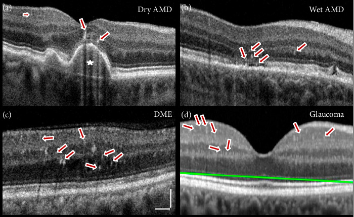 Retinal Hyperreflective Foci Are Biomarkers of Ocular Disease: A Scoping Review With Evidence From Humans and Insights From Animal Models.